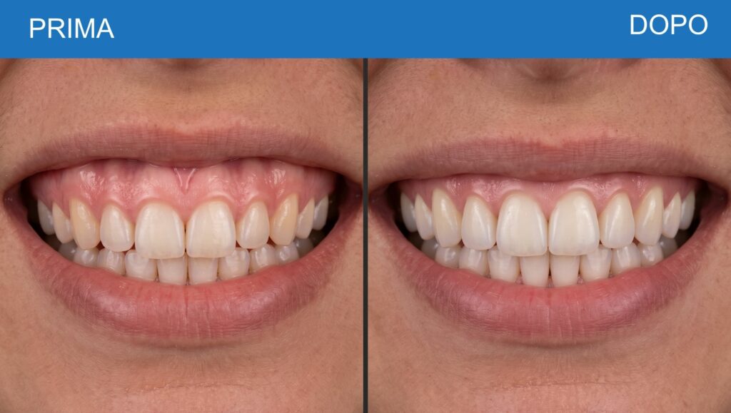 CORREZZIONE DI UN SORRISO GENGIVALE ALTO PRIMA E DOPO IL TRATTAMENTO